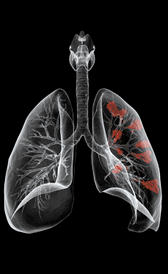 Imagen de la cáncer de pulmón
