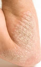 Imagen del eczema
