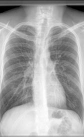 Imagen de la enfermedad pulmonar obstructiva cronica