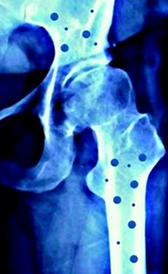 Imagen de la osteoporosis